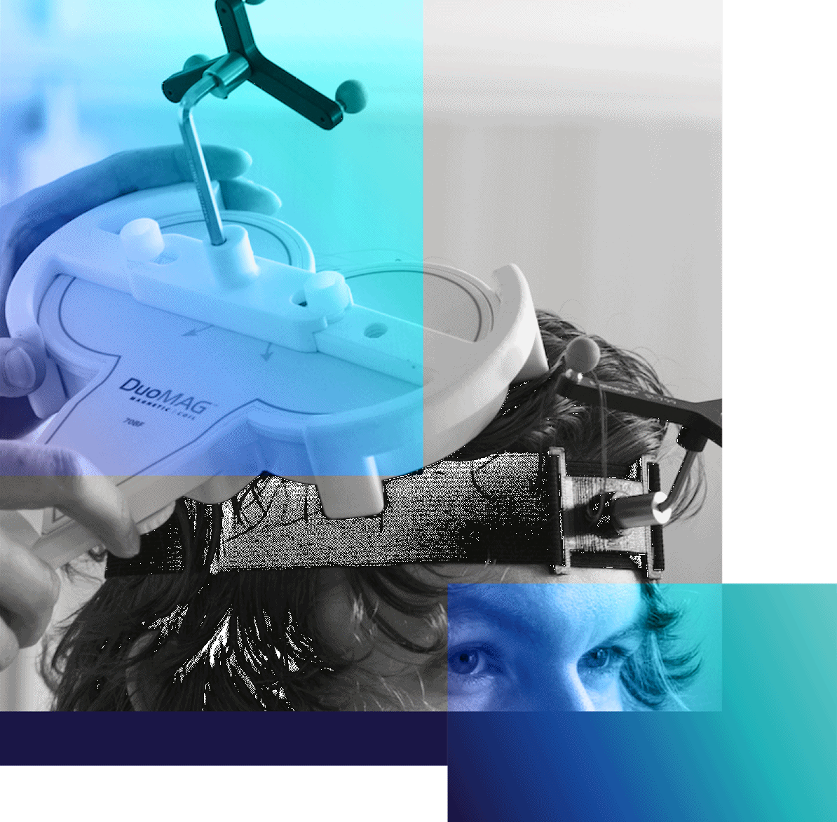 Pharmaco-TMS and qEEG in Rare Myclonic Epilepsy Condition