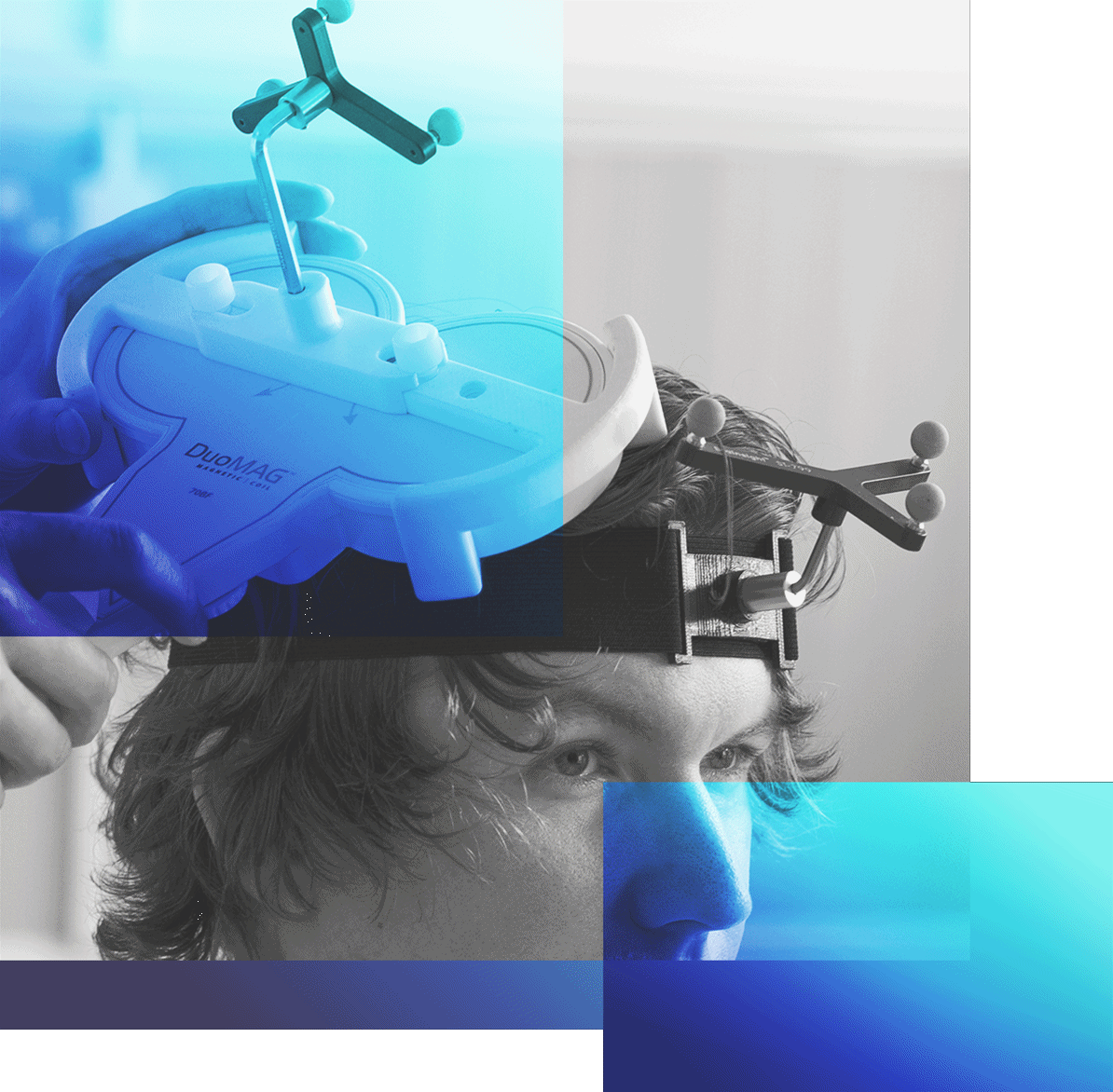 Pharmaco-TMS and qEEG in Rare Myclonic Epilepsy Condition